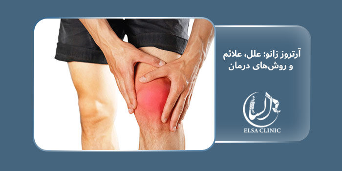 آرتروز زانو: علل، علائم و روش‌های درمان