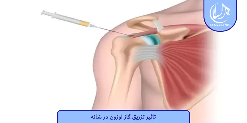 تاثیر تزریق گاز اوزون در شانه