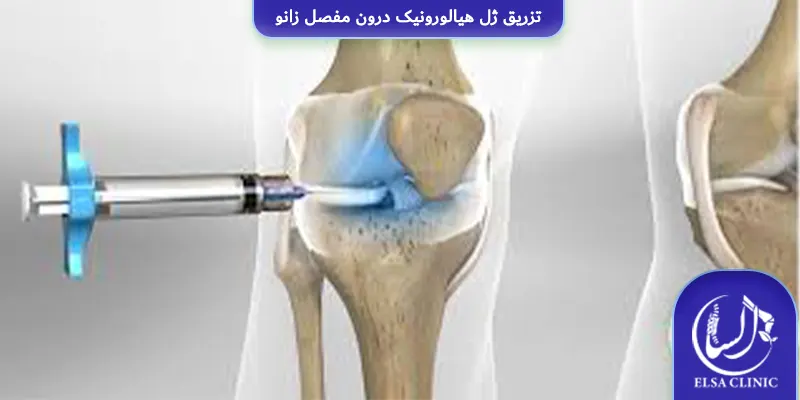تزریق ژل هیالورونیک درون مفصل زانو